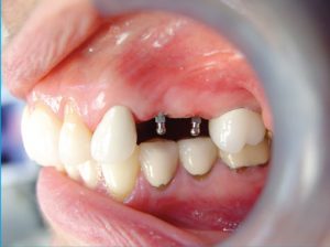 maryland-mini-implants-2-300x224 Mini Dental Implants mini dental implants Emeryville