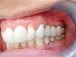 maryland-mini-implants-3-300x224 Mini Dental Implants mini dental implants Emeryville